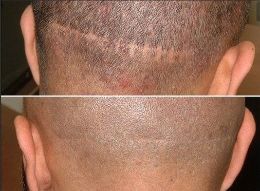 Tricopigmentazione per coprire cicatrici sul cuoio capelluto a Taranto